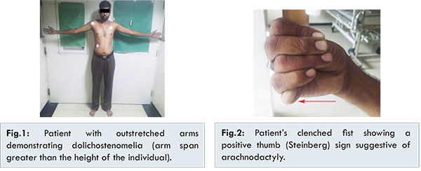 Marfan Syndrome Arm Span marfan-syndrome-arm-span
